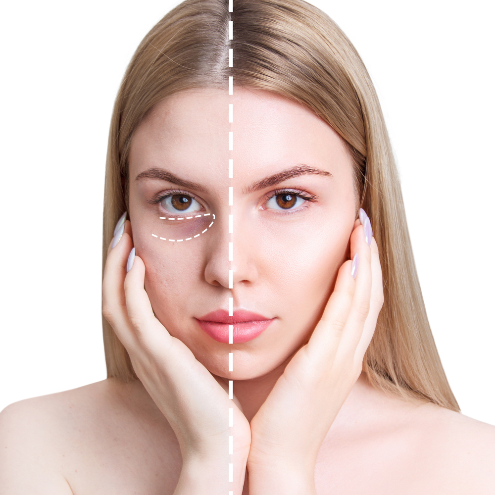 Göz Altı Torbaları